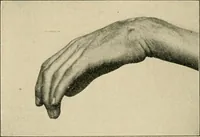 An illustration from Atlas and epitome of diseases caused by accidents / by Dr. Ed. Golebiewski ... authorized translation from the German, with editorial notes and additions by Pearce Bailey ... 40 colored plates, and 143 illustrations in black. (1900)