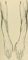 An illustration from Atlas and epitome of diseases caused by accidents / by Dr. Ed. Golebiewski ... authorized translation from the German, with editorial notes and additions by Pearce Bailey ... 40 colored plates, and 143 illustrations in black. (1900)