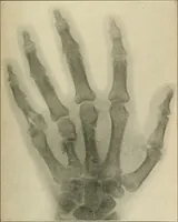 An illustration from Atlas and epitome of diseases caused by accidents / by Dr. Ed. Golebiewski ... authorized translation from the German, with editorial notes and additions by Pearce Bailey ... 40 colored plates, and 143 illustrations in black. (1900)