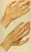 An illustration from Atlas and epitome of diseases caused by accidents / by Dr. Ed. Golebiewski ... authorized translation from the German, with editorial notes and additions by Pearce Bailey ... 40 colored plates, and 143 illustrations in black. (1900)