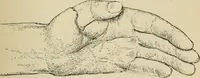 An illustration from Atlas and epitome of diseases caused by accidents / by Dr. Ed. Golebiewski ... authorized translation from the German, with editorial notes and additions by Pearce Bailey ... 40 colored plates, and 143 illustrations in black. (1900)