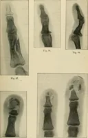 An illustration from Atlas and epitome of diseases caused by accidents / by Dr. Ed. Golebiewski ... authorized translation from the German, with editorial notes and additions by Pearce Bailey ... 40 colored plates, and 143 illustrations in black. (1900)