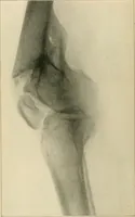 An illustration from Atlas and epitome of diseases caused by accidents / by Dr. Ed. Golebiewski ... authorized translation from the German, with editorial notes and additions by Pearce Bailey ... 40 colored plates, and 143 illustrations in black. (1900)