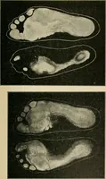 An illustration from Atlas and epitome of diseases caused by accidents / by Dr. Ed. Golebiewski ... authorized translation from the German, with editorial notes and additions by Pearce Bailey ... 40 colored plates, and 143 illustrations in black. (1900)