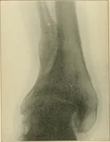 An illustration from Atlas and epitome of diseases caused by accidents / by Dr. Ed. Golebiewski ... authorized translation from the German, with editorial notes and additions by Pearce Bailey ... 40 colored plates, and 143 illustrations in black. (1900)