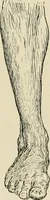 An illustration from Atlas and epitome of diseases caused by accidents / by Dr. Ed. Golebiewski ... authorized translation from the German, with editorial notes and additions by Pearce Bailey ... 40 colored plates, and 143 illustrations in black. (1900)