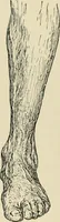 An illustration from Atlas and epitome of diseases caused by accidents / by Dr. Ed. Golebiewski ... authorized translation from the German, with editorial notes and additions by Pearce Bailey ... 40 colored plates, and 143 illustrations in black. (1900)