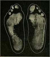 An illustration from Atlas and epitome of diseases caused by accidents / by Dr. Ed. Golebiewski ... authorized translation from the German, with editorial notes and additions by Pearce Bailey ... 40 colored plates, and 143 illustrations in black. (1900)