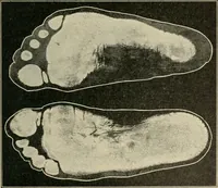 Picture 46 of 65 from Atlas and epitome of diseases caused by accidents / by Dr. Ed. Golebiewski ... authorized translation from the German, with editorial notes and additions by Pearce Bailey ... 40 colored plates, and 143 illustrations in black. (1900), leaf 573