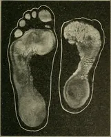 Picture 48 of 65 from Atlas and epitome of diseases caused by accidents / by Dr. Ed. Golebiewski ... authorized translation from the German, with editorial notes and additions by Pearce Bailey ... 40 colored plates, and 143 illustrations in black. (1900), leaf 593