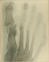 An illustration from Atlas and epitome of diseases caused by accidents / by Dr. Ed. Golebiewski ... authorized translation from the German, with editorial notes and additions by Pearce Bailey ... 40 colored plates, and 143 illustrations in black. (1900)