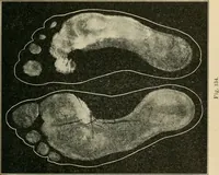An illustration from Atlas and epitome of diseases caused by accidents / by Dr. Ed. Golebiewski ... authorized translation from the German, with editorial notes and additions by Pearce Bailey ... 40 colored plates, and 143 illustrations in black. (1900)