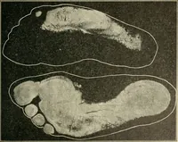 An illustration from Atlas and epitome of diseases caused by accidents / by Dr. Ed. Golebiewski ... authorized translation from the German, with editorial notes and additions by Pearce Bailey ... 40 colored plates, and 143 illustrations in black. (1900)