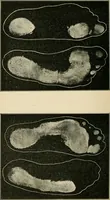 Picture 58 of 65 from Atlas and epitome of diseases caused by accidents / by Dr. Ed. Golebiewski ... authorized translation from the German, with editorial notes and additions by Pearce Bailey ... 40 colored plates, and 143 illustrations in black. (1900), leaf 608