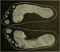 An illustration from Atlas and epitome of diseases caused by accidents / by Dr. Ed. Golebiewski ... authorized translation from the German, with editorial notes and additions by Pearce Bailey ... 40 colored plates, and 143 illustrations in black. (1900)
