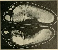 An illustration from Atlas and epitome of diseases caused by accidents / by Dr. Ed. Golebiewski ... authorized translation from the German, with editorial notes and additions by Pearce Bailey ... 40 colored plates, and 143 illustrations in black. (1900)