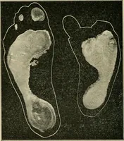 Picture 62 of 65 from Atlas and epitome of diseases caused by accidents / by Dr. Ed. Golebiewski ... authorized translation from the German, with editorial notes and additions by Pearce Bailey ... 40 colored plates, and 143 illustrations in black. (1900), leaf 616