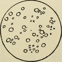 An illustration from Diseases of infancy and childhood, their dietetic, hygienic, and medical treatment : a text-book designed for practitioners and students in medicine / By Louis Fischer. (1910)