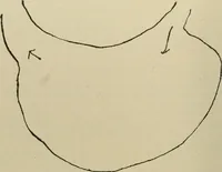An illustration from Diseases of infancy and childhood, their dietetic, hygienic, and medical treatment : a text-book designed for practitioners and students in medicine / By Louis Fischer. (1910)