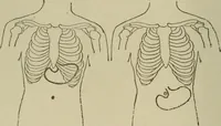 An illustration from Diseases of infancy and childhood, their dietetic, hygienic, and medical treatment : a text-book designed for practitioners and students in medicine / By Louis Fischer. (1910)