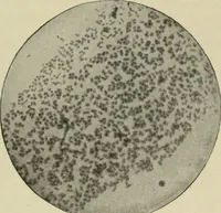 An illustration from Diseases of infancy and childhood, their dietetic, hygienic, and medical treatment : a text-book designed for practitioners and students in medicine / By Louis Fischer. (1910)