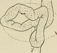 An illustration from Diseases of infancy and childhood, their dietetic, hygienic, and medical treatment : a text-book designed for practitioners and students in medicine / By Louis Fischer. (1910)
