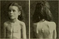 An illustration from Diseases of infancy and childhood, their dietetic, hygienic, and medical treatment : a text-book designed for practitioners and students in medicine / By Louis Fischer. (1910)