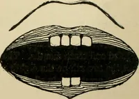 An illustration from Diseases of infancy and childhood, their dietetic, hygienic, and medical treatment : a text-book designed for practitioners and students in medicine / By Louis Fischer. (1910)