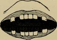 An illustration from Diseases of infancy and childhood, their dietetic, hygienic, and medical treatment : a text-book designed for practitioners and students in medicine / By Louis Fischer. (1910)