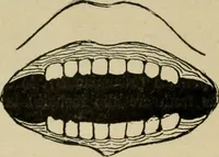 An illustration from Diseases of infancy and childhood, their dietetic, hygienic, and medical treatment : a text-book designed for practitioners and students in medicine / By Louis Fischer. (1910)