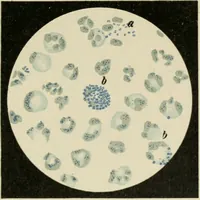 An illustration from Diseases of infancy and childhood, their dietetic, hygienic, and medical treatment : a text-book designed for practitioners and students in medicine / By Louis Fischer. (1910)