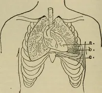 An illustration from Diseases of infancy and childhood, their dietetic, hygienic, and medical treatment : a text-book designed for practitioners and students in medicine / By Louis Fischer. (1910)
