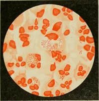 An illustration from Diseases of infancy and childhood, their dietetic, hygienic, and medical treatment : a text-book designed for practitioners and students in medicine / By Louis Fischer. (1910)