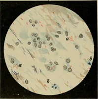 An illustration from Diseases of infancy and childhood, their dietetic, hygienic, and medical treatment : a text-book designed for practitioners and students in medicine / By Louis Fischer. (1910)