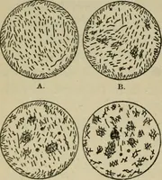 An illustration from Diseases of infancy and childhood, their dietetic, hygienic, and medical treatment : a text-book designed for practitioners and students in medicine / By Louis Fischer. (1910)