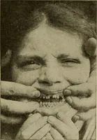 An illustration from Diseases of infancy and childhood, their dietetic, hygienic, and medical treatment : a text-book designed for practitioners and students in medicine / By Louis Fischer. (1910)