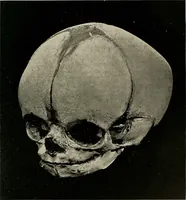 An illustration from Diseases of infancy and childhood, their dietetic, hygienic, and medical treatment : a text-book designed for practitioners and students in medicine / By Louis Fischer. (1910)