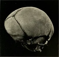 An illustration from Diseases of infancy and childhood, their dietetic, hygienic, and medical treatment : a text-book designed for practitioners and students in medicine / By Louis Fischer. (1910)
