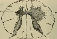 An illustration from Diseases of infancy and childhood, their dietetic, hygienic, and medical treatment : a text-book designed for practitioners and students in medicine / By Louis Fischer. (1910)