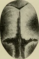 An illustration from Diseases of infancy and childhood, their dietetic, hygienic, and medical treatment : a text-book designed for practitioners and students in medicine / By Louis Fischer. (1910)