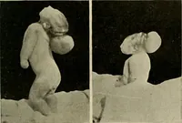 An illustration from Diseases of infancy and childhood, their dietetic, hygienic, and medical treatment : a text-book designed for practitioners and students in medicine / By Louis Fischer. (1910)