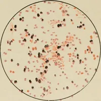 An illustration from Diseases of infancy and childhood, their dietetic, hygienic, and medical treatment : a text-book designed for practitioners and students in medicine / By Louis Fischer. (1910)
