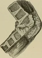 An illustration from Diseases of infancy and childhood, their dietetic, hygienic, and medical treatment : a text-book designed for practitioners and students in medicine / By Louis Fischer. (1910)