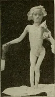 An illustration from Diseases of infancy and childhood, their dietetic, hygienic, and medical treatment : a text-book designed for practitioners and students in medicine / By Louis Fischer. (1910)