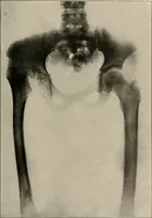 An illustration from Diseases of infancy and childhood, their dietetic, hygienic, and medical treatment : a text-book designed for practitioners and students in medicine / By Louis Fischer. (1910)