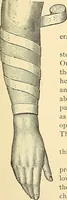 An illustration from Surgical technic; a text-book on operative surgery / by Fr. von Esmarch ... and E. Kowalzig ... translated by Professor Ludwig H. Grau ... and Willam N. Sullivan ... edited by Nicholas Senn ... With fourteen hundred and ninety-seven illustrations and fifteen colored plates. (1901)