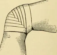 An illustration from Surgical technic; a text-book on operative surgery / by Fr. von Esmarch ... and E. Kowalzig ... translated by Professor Ludwig H. Grau ... and Willam N. Sullivan ... edited by Nicholas Senn ... With fourteen hundred and ninety-seven illustrations and fifteen colored plates. (1901)