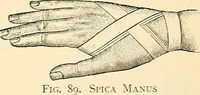 An illustration from Surgical technic; a text-book on operative surgery / by Fr. von Esmarch ... and E. Kowalzig ... translated by Professor Ludwig H. Grau ... and Willam N. Sullivan ... edited by Nicholas Senn ... With fourteen hundred and ninety-seven illustrations and fifteen colored plates. (1901)