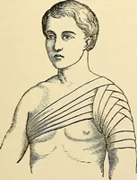 An illustration from Surgical technic; a text-book on operative surgery / by Fr. von Esmarch ... and E. Kowalzig ... translated by Professor Ludwig H. Grau ... and Willam N. Sullivan ... edited by Nicholas Senn ... With fourteen hundred and ninety-seven illustrations and fifteen colored plates. (1901)