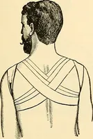 An illustration from Surgical technic; a text-book on operative surgery / by Fr. von Esmarch ... and E. Kowalzig ... translated by Professor Ludwig H. Grau ... and Willam N. Sullivan ... edited by Nicholas Senn ... With fourteen hundred and ninety-seven illustrations and fifteen colored plates. (1901)